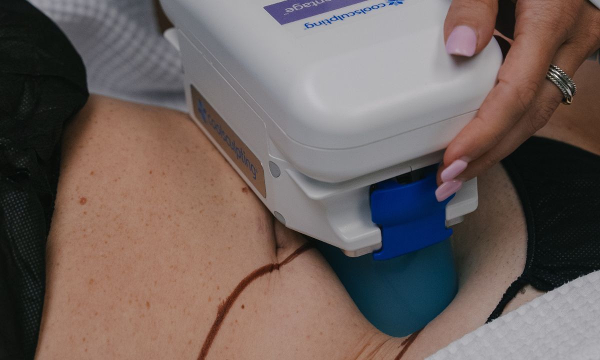 Coolsculpting Fairfield County CT