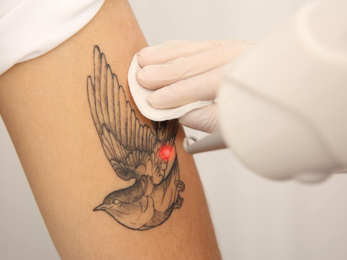 Laser Tattoo Removal Treatment in Darien CT