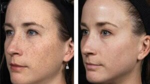 Fraxel laser skin resurfacing Skin rejuvenation Darien CT Versailles Medical Spa Laser treatments Fairfield County Anti-aging treatments Darien CT Non-surgical skin resurfacing Wrinkle reduction Darien CT Sun damage treatment Acne scar removal Skin texture improvement