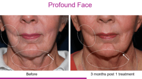 Profound skin tightening Non-surgical facelift Radiofrequency microneedling Skin rejuvenation Darien CT Anti-aging treatments Collagen stimulation Elastin production Wrinkle reduction Skin tightening Darien CT Youthful skin treatments