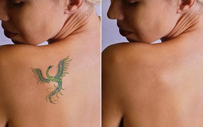 Laser tattoo removal Darien CT Tattoo removal process Tattoo removal sessions Pain management tattoo removal Tattoo removal cost Darien CT Effective tattoo removal Unwanted tattoo removal Tattoo removal consultation Darien CT Skin rejuvenation Darien CT Medical spa Darien CT