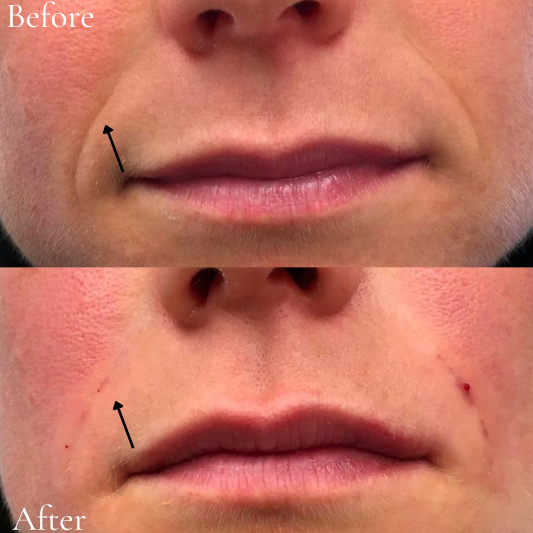 Juvederm (2)