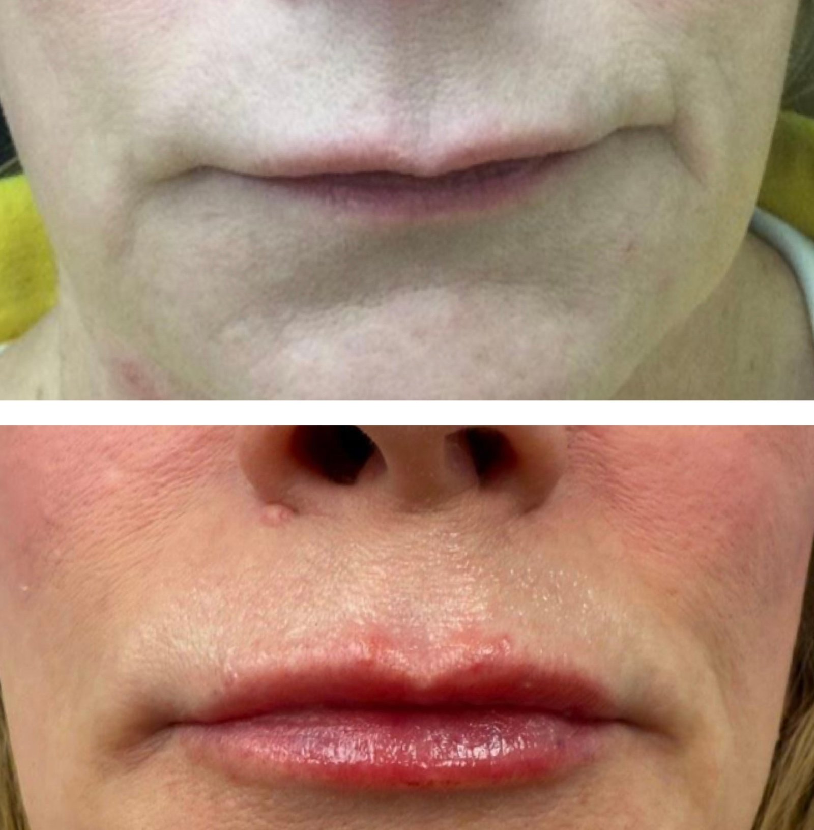 Lip filler before and after