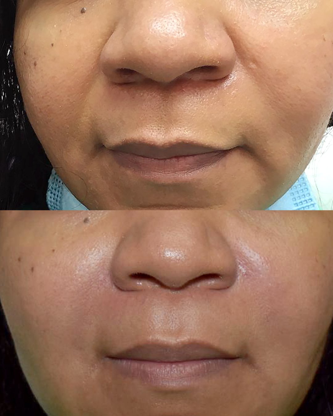 Nasolabial folds filler