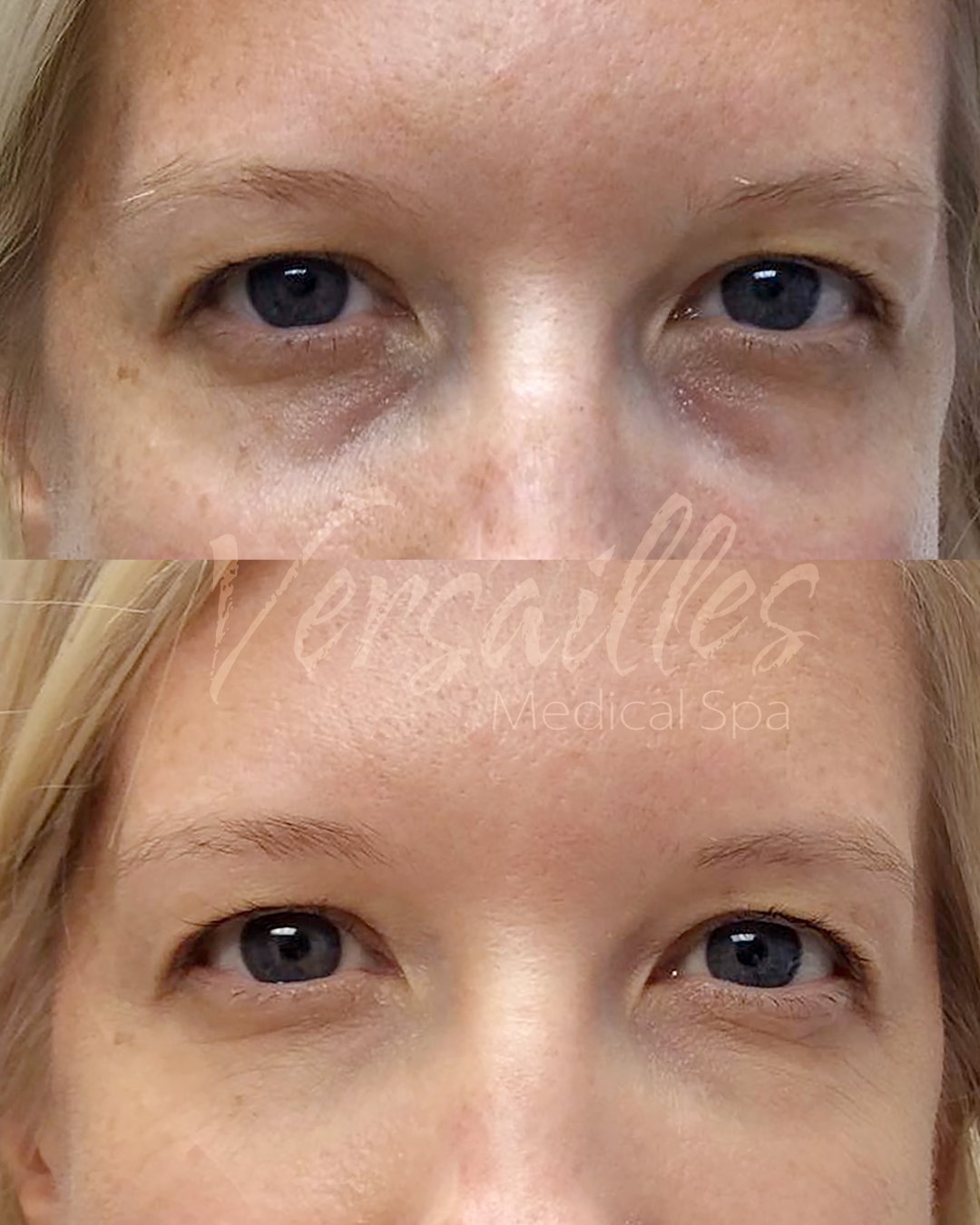 Undereye Filler B&A