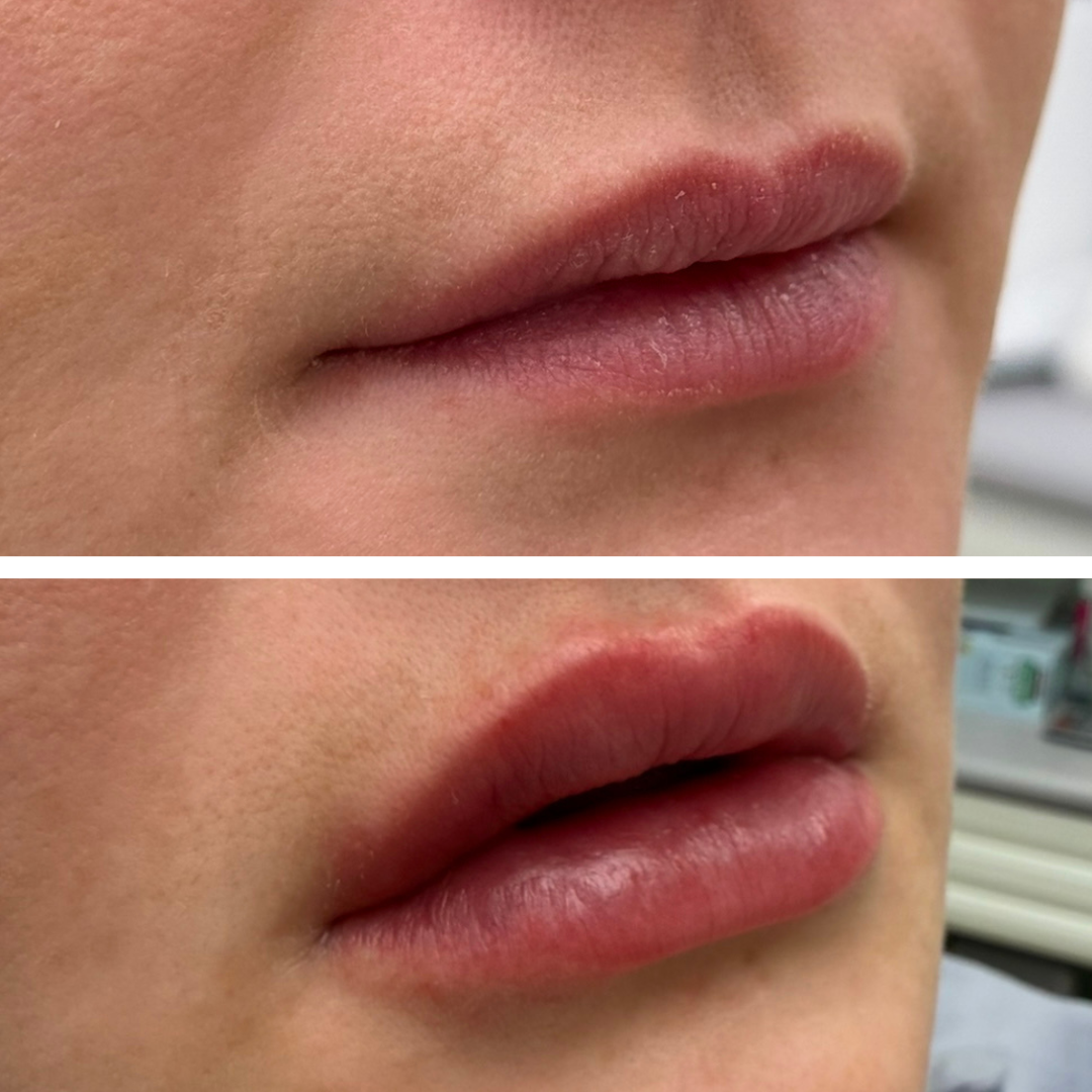 lips Restylane