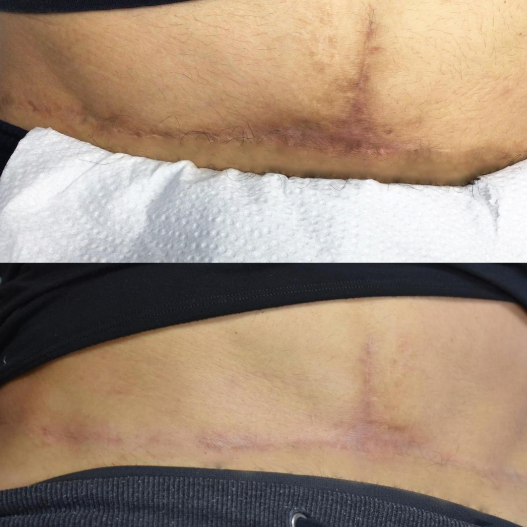 Fraxel Dual Scar