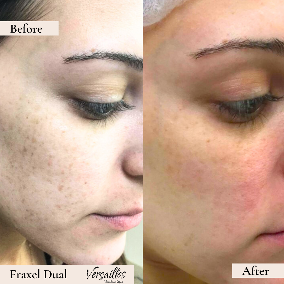 Fraxel Dual Skin Resurfacing