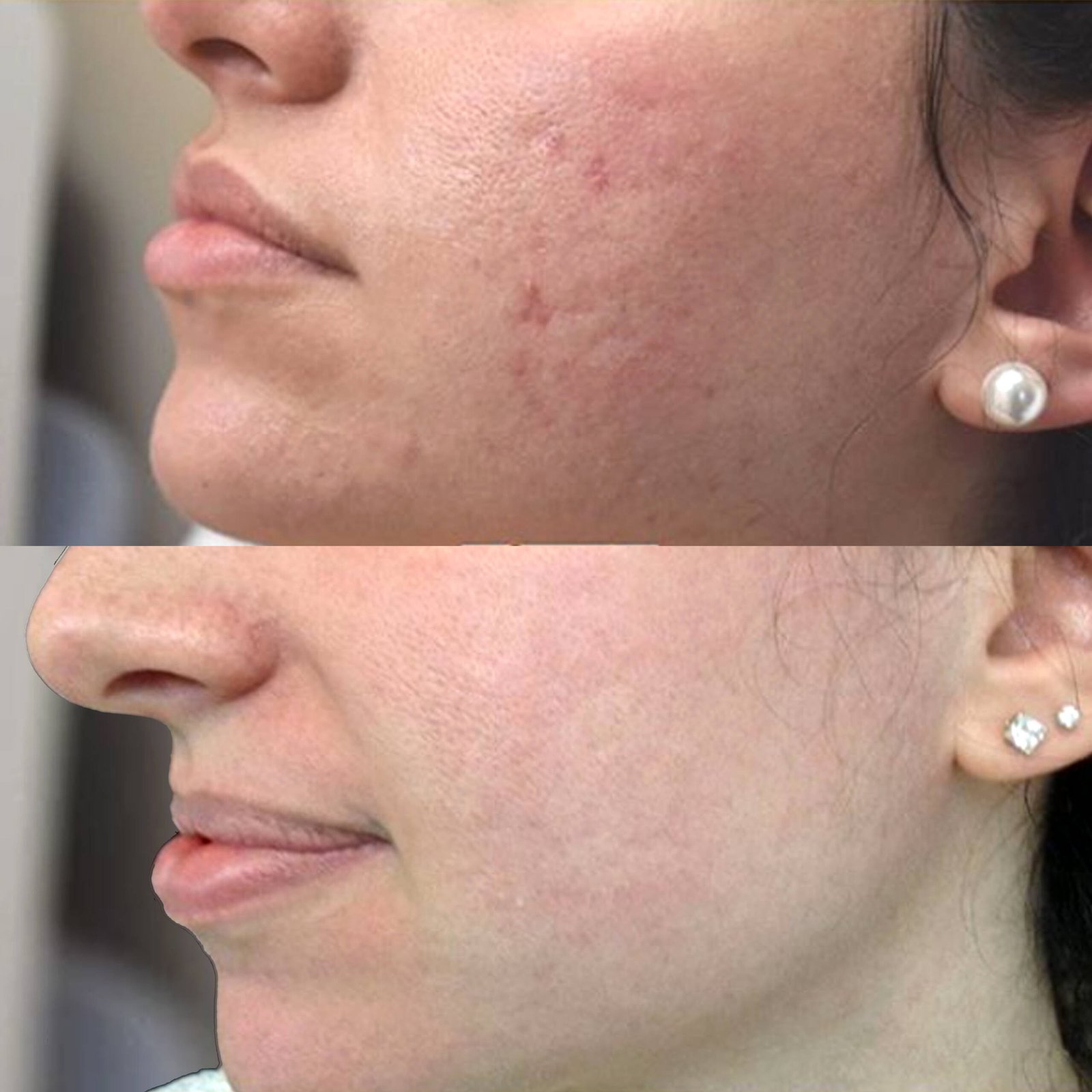 Fraxel b&a acne