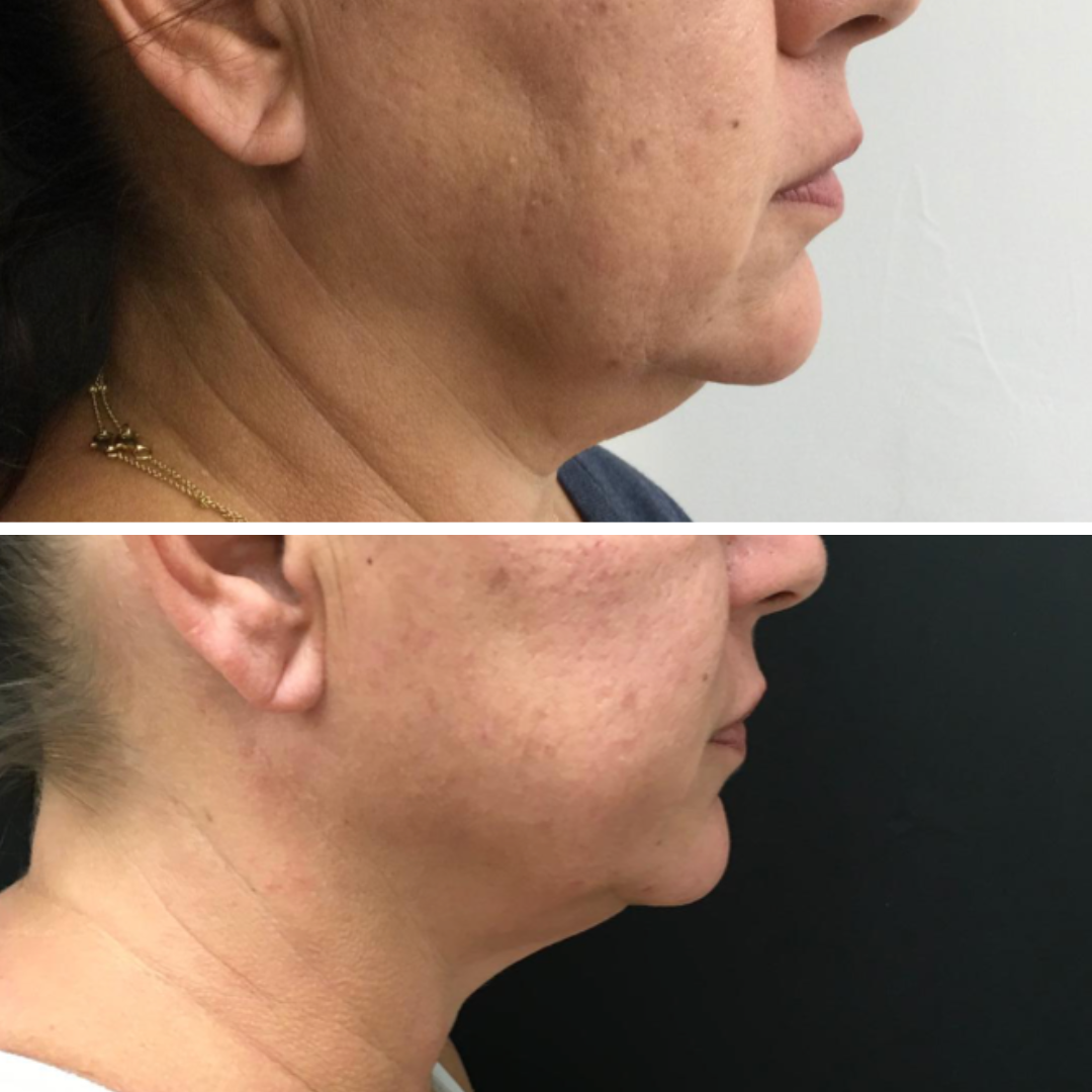 Kybella double chin