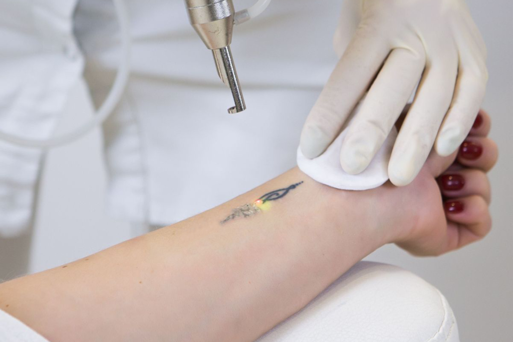 Laser Tattoo Removal in Fairfield County, CT