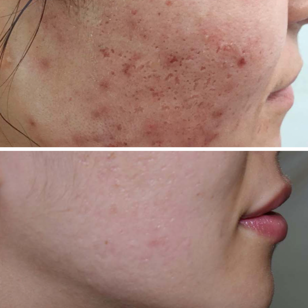 Microneedling