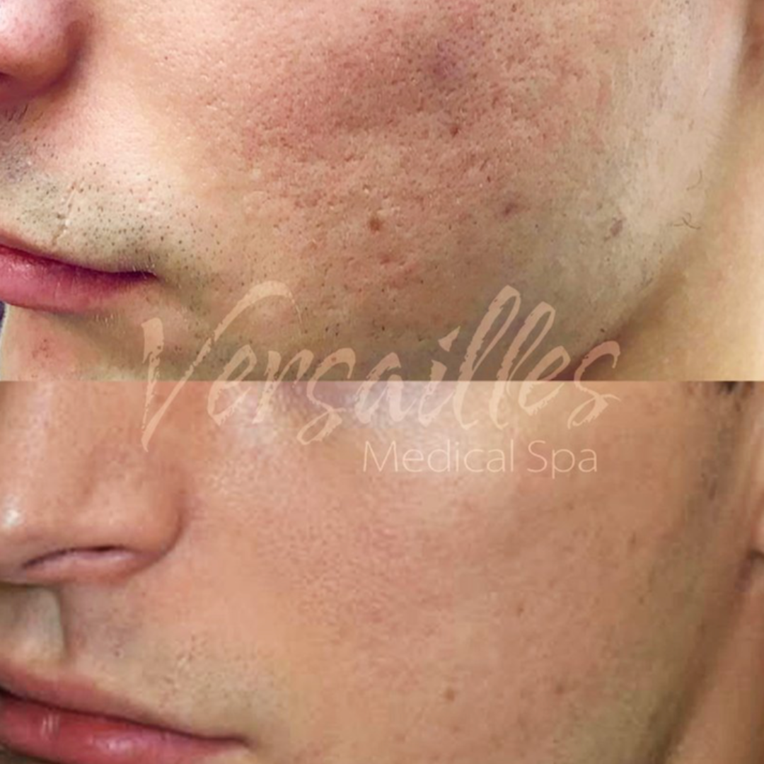 Microneedling (2)