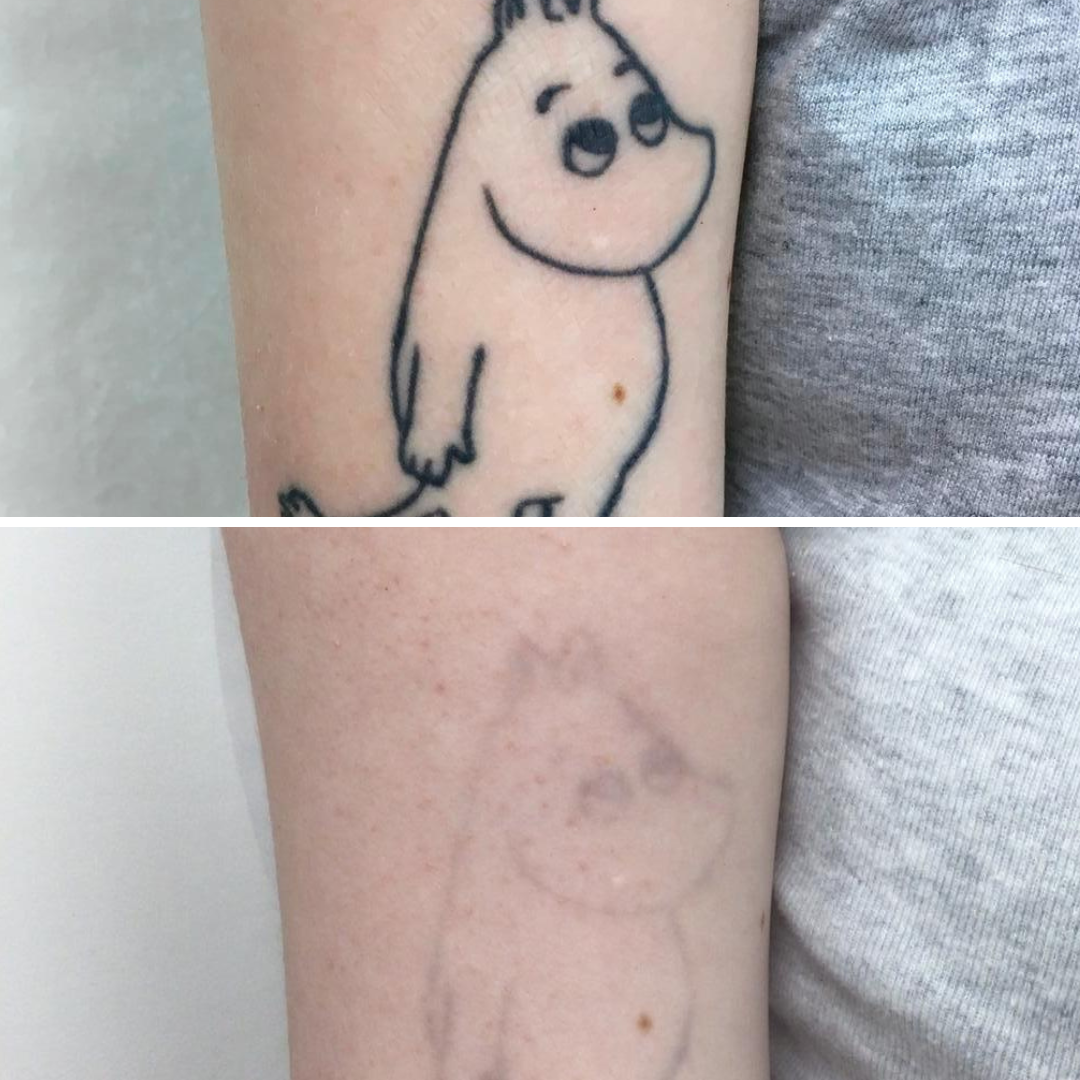Tattoo Removal