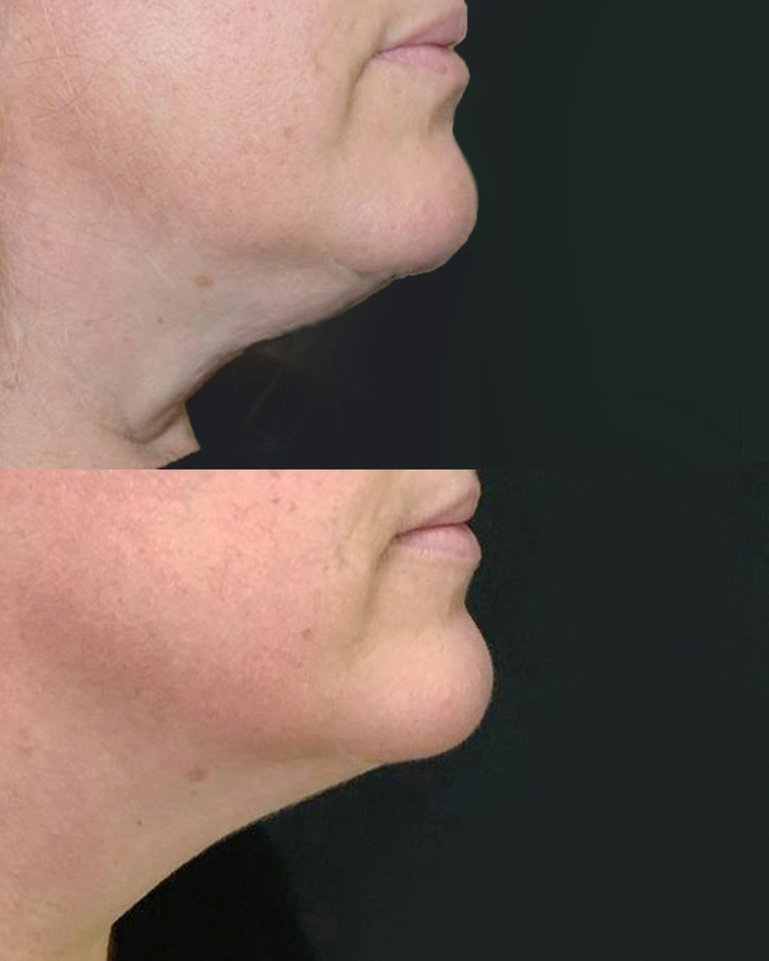 kybella B&A right