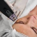 Smooth & Tighten: Combining Morpheus8 and Profound RF for Body Rejuvenation