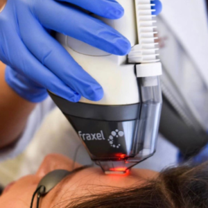 Fraxel laser Darien