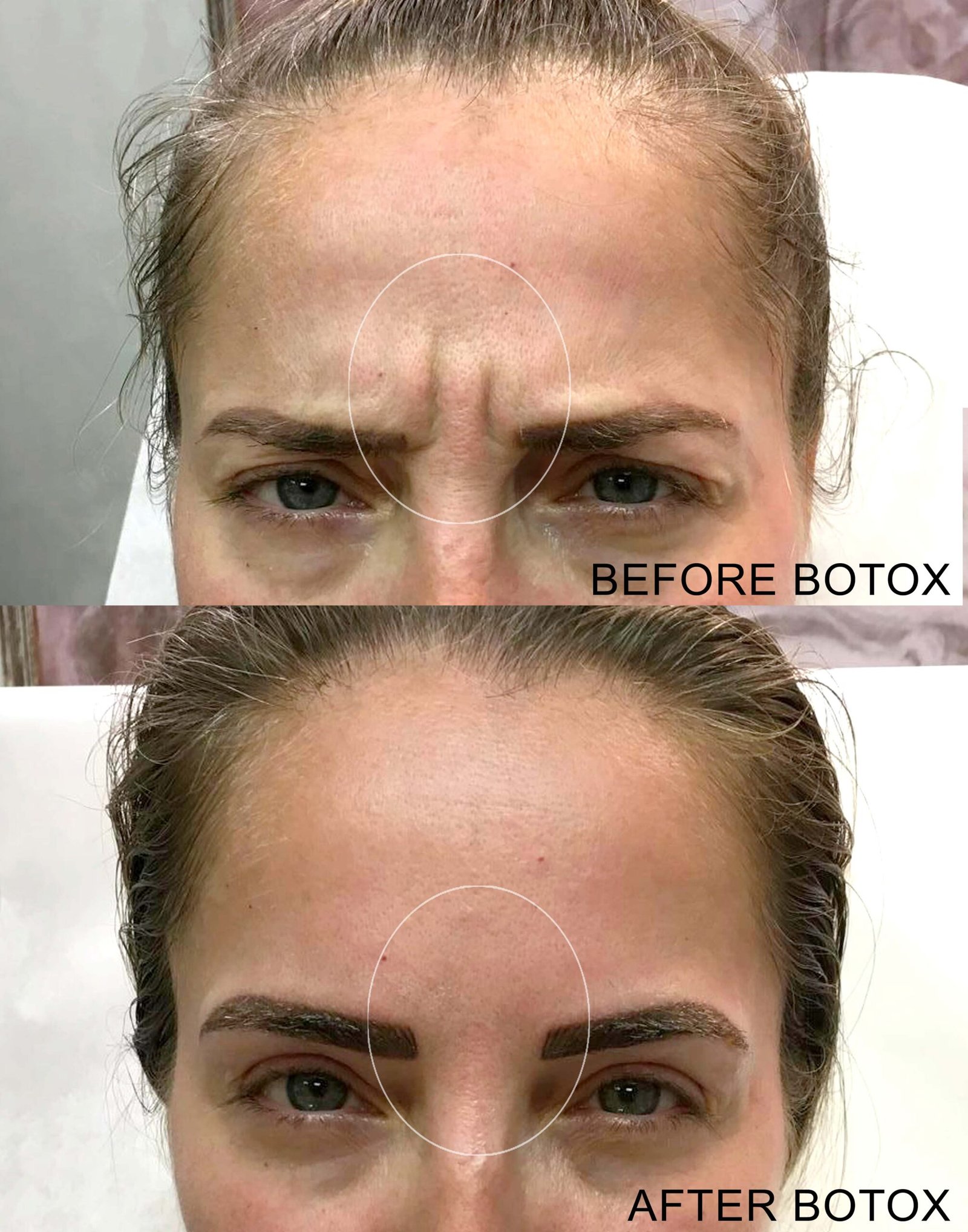 BOTOX B&A ANGRY