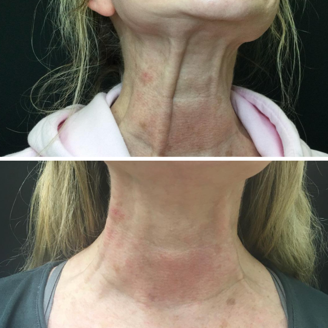 Botox Platysma