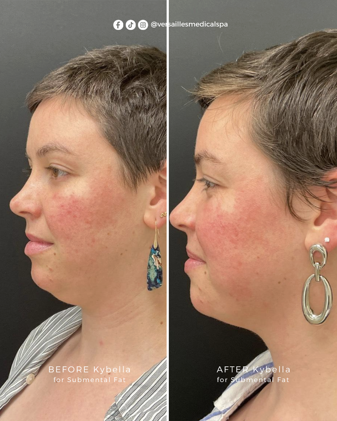 Kybella 01 copy