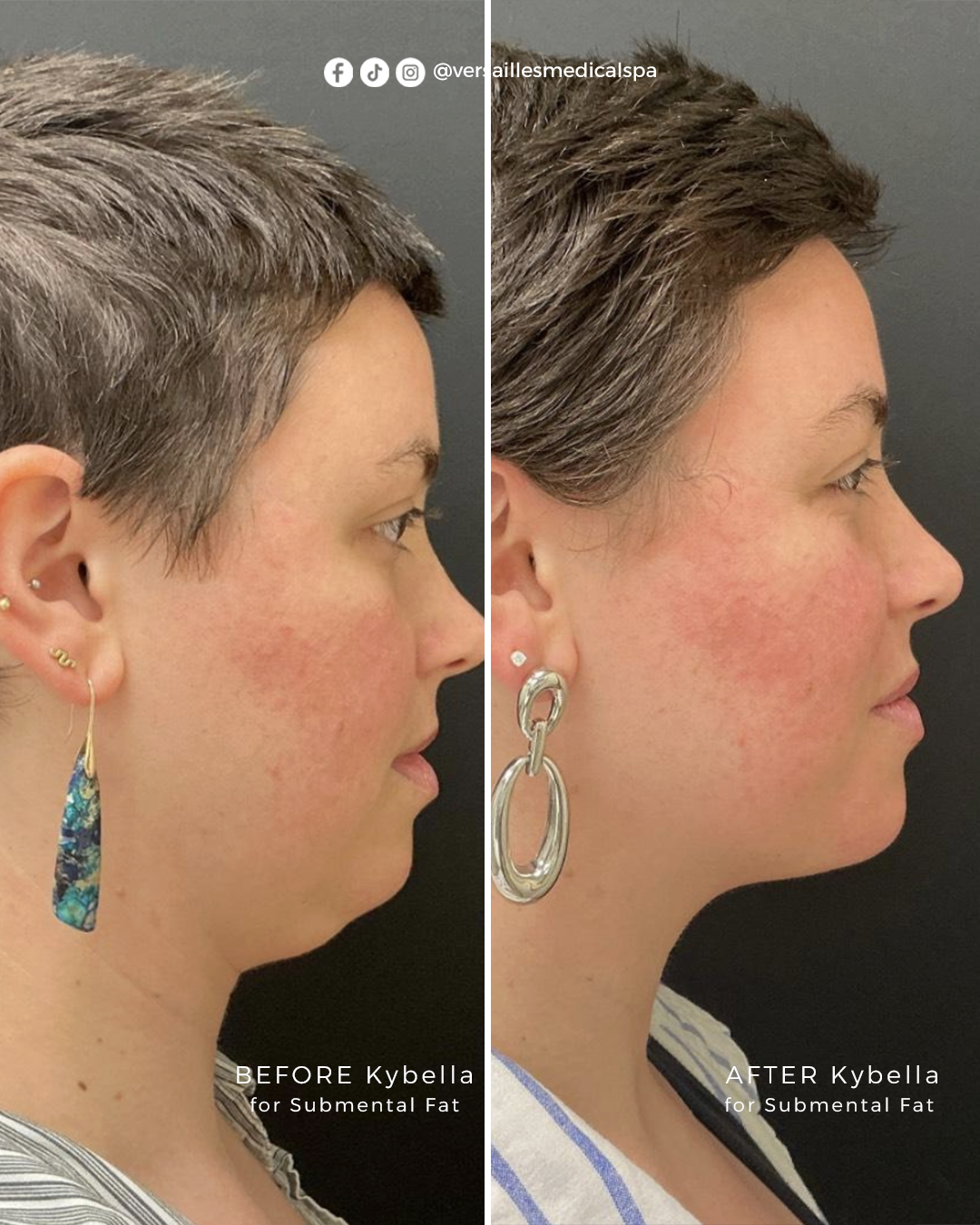 Kybella 01