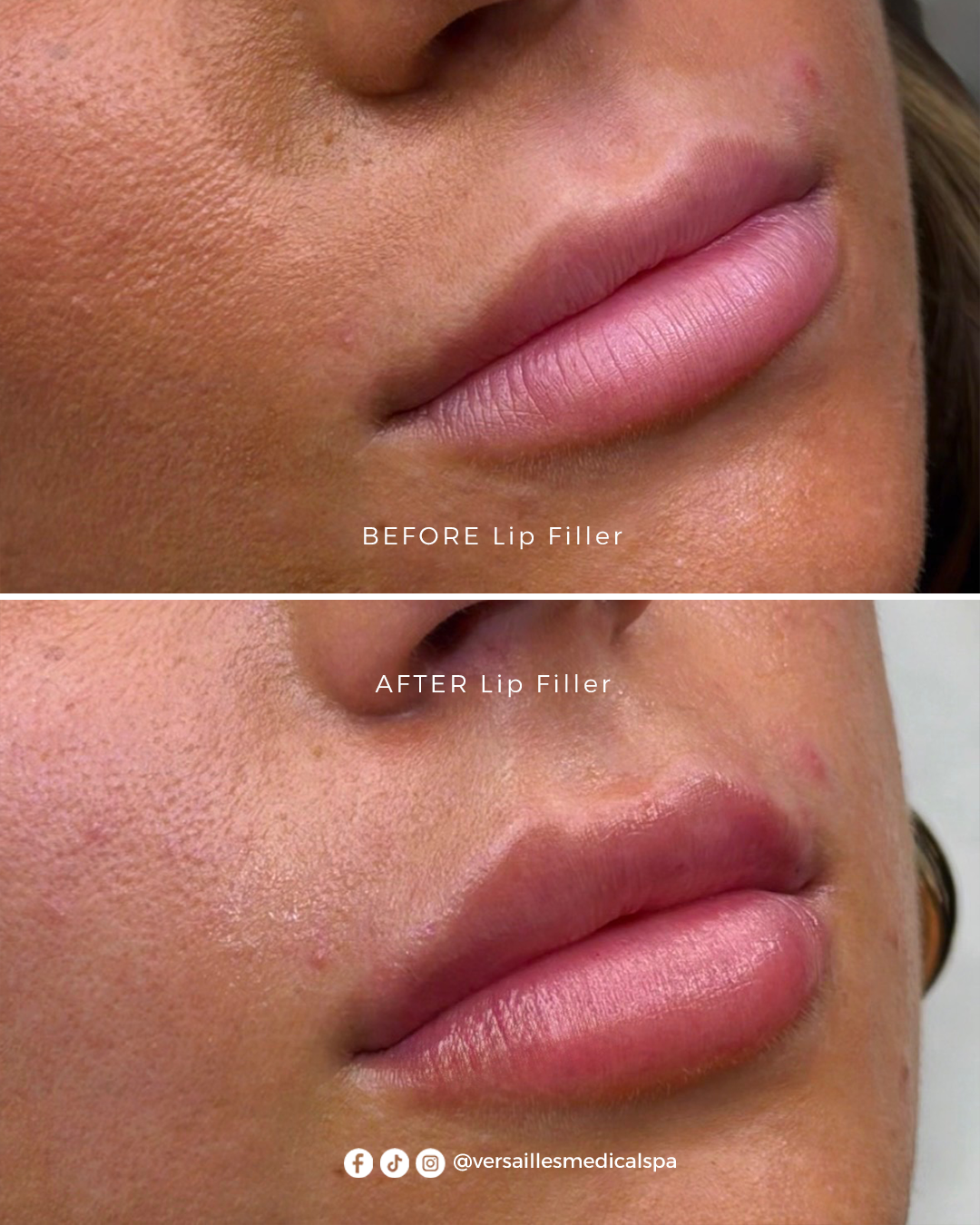 LIP FILLER B+A 2
