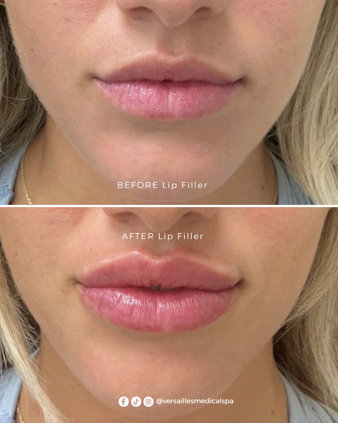 LIP FILLER