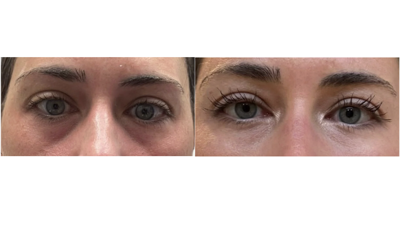 PRF EZ before and after