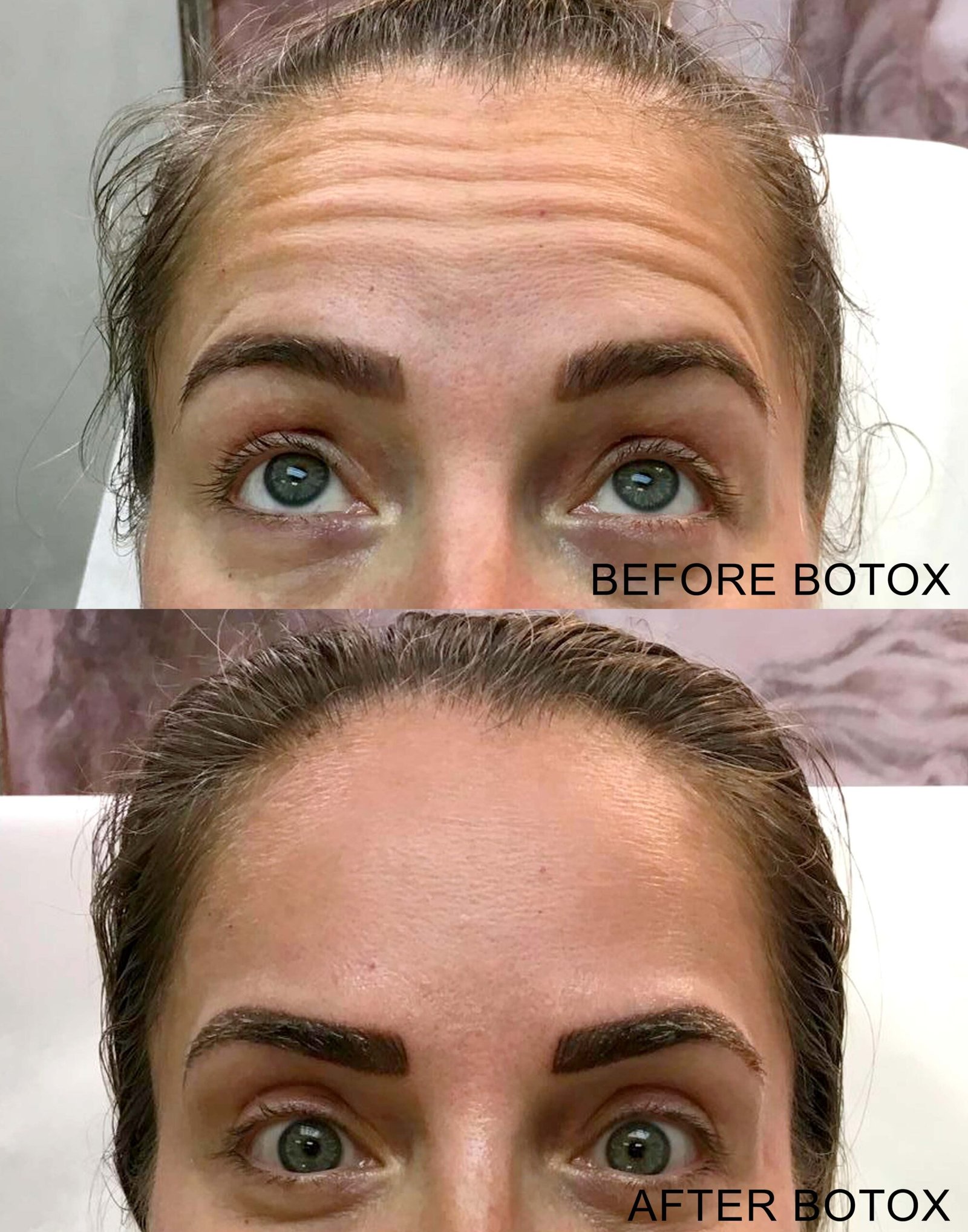 botox b&a surprised