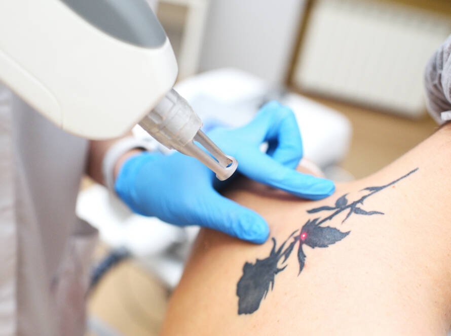 tattoo removal Darien