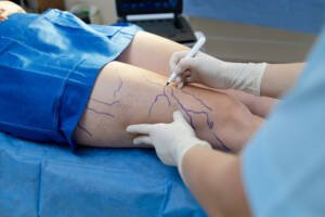 sclerotherapy Darien