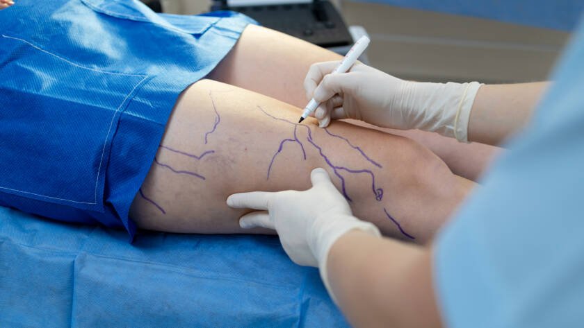 sclerotherapy Darien