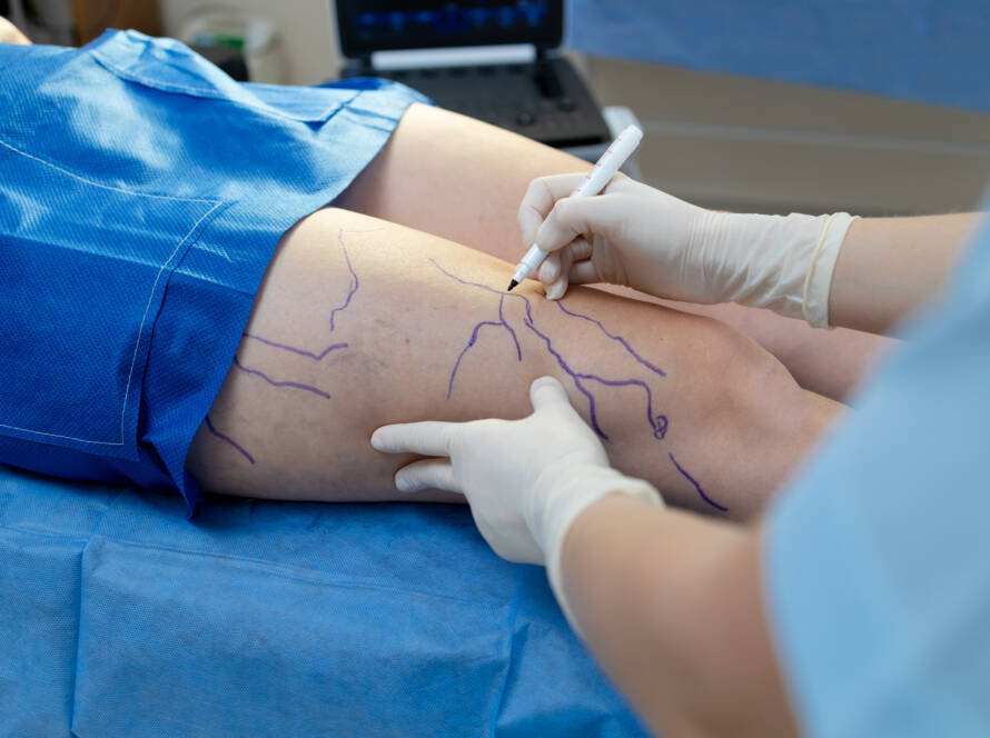 sclerotherapy Darien