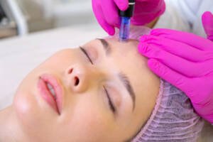 microneedling Stamford