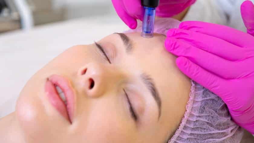 microneedling Stamford