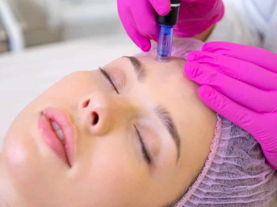 microneedling Stamford