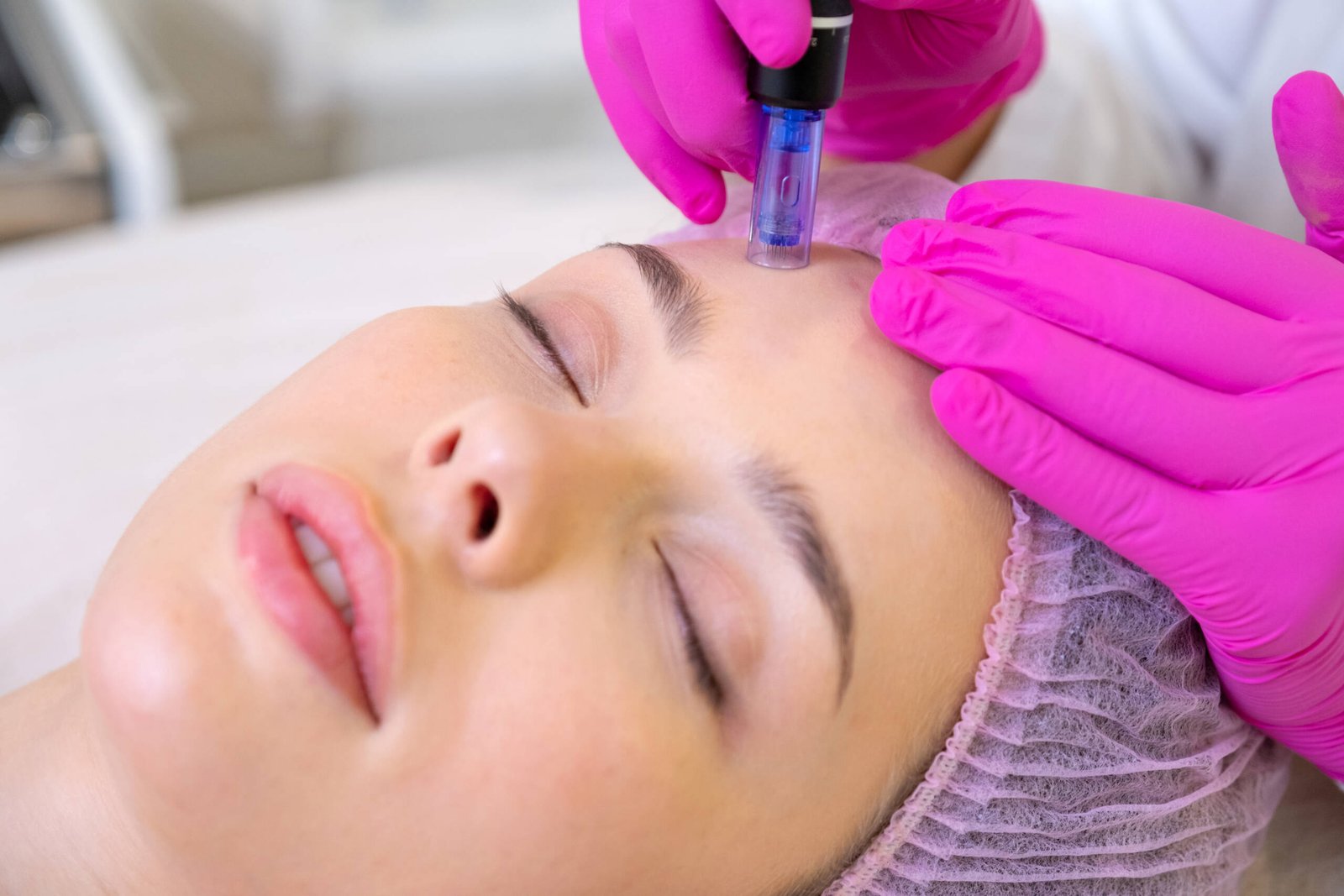 microneedling Stamford