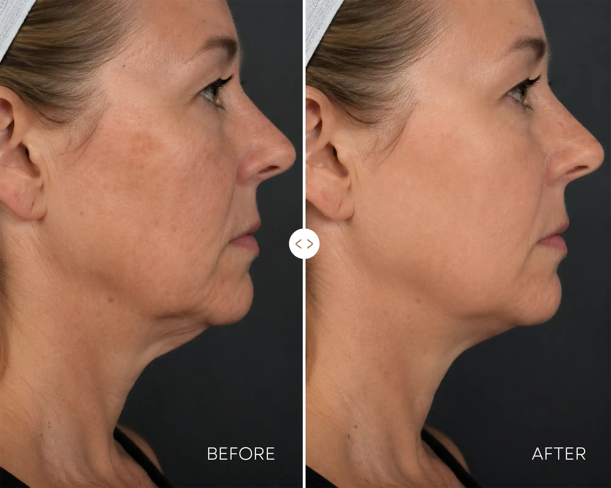 Before / After — Jawline definition