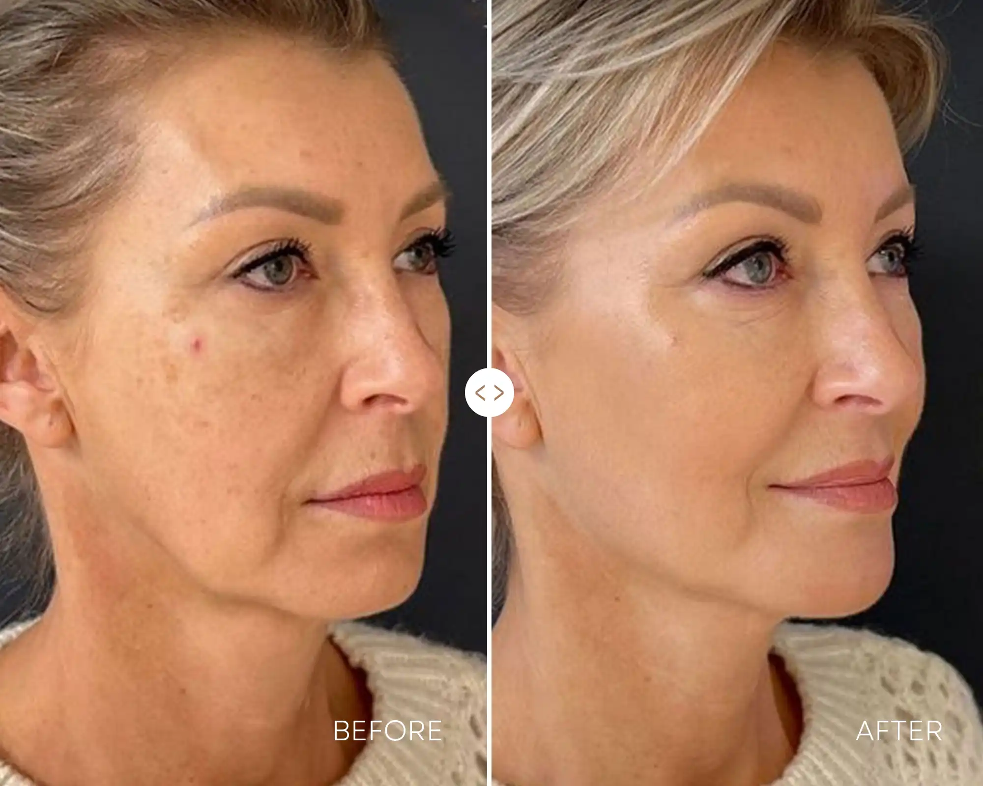 Before / After — Jawline definition