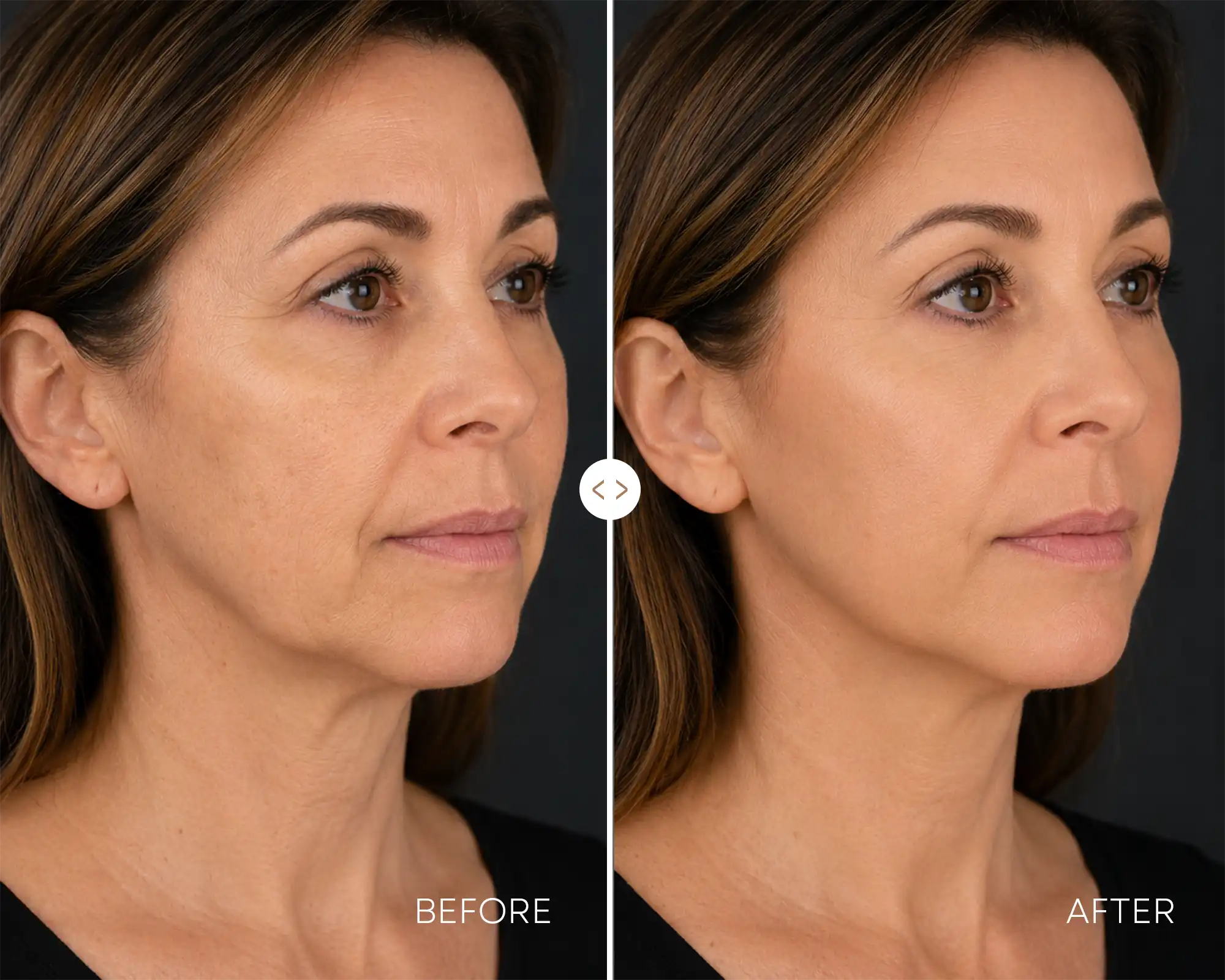 Before / After — Jawline definition