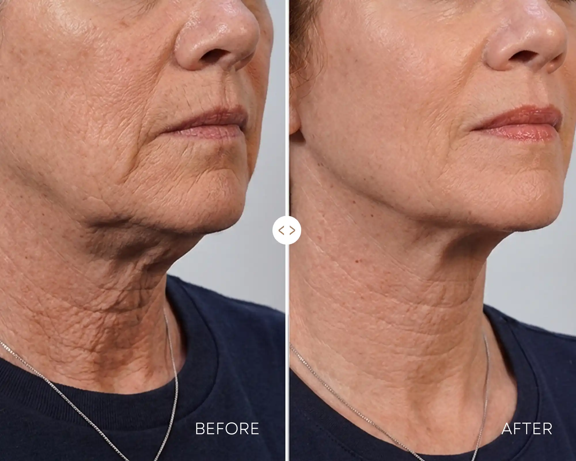 Lower face & neck tightening