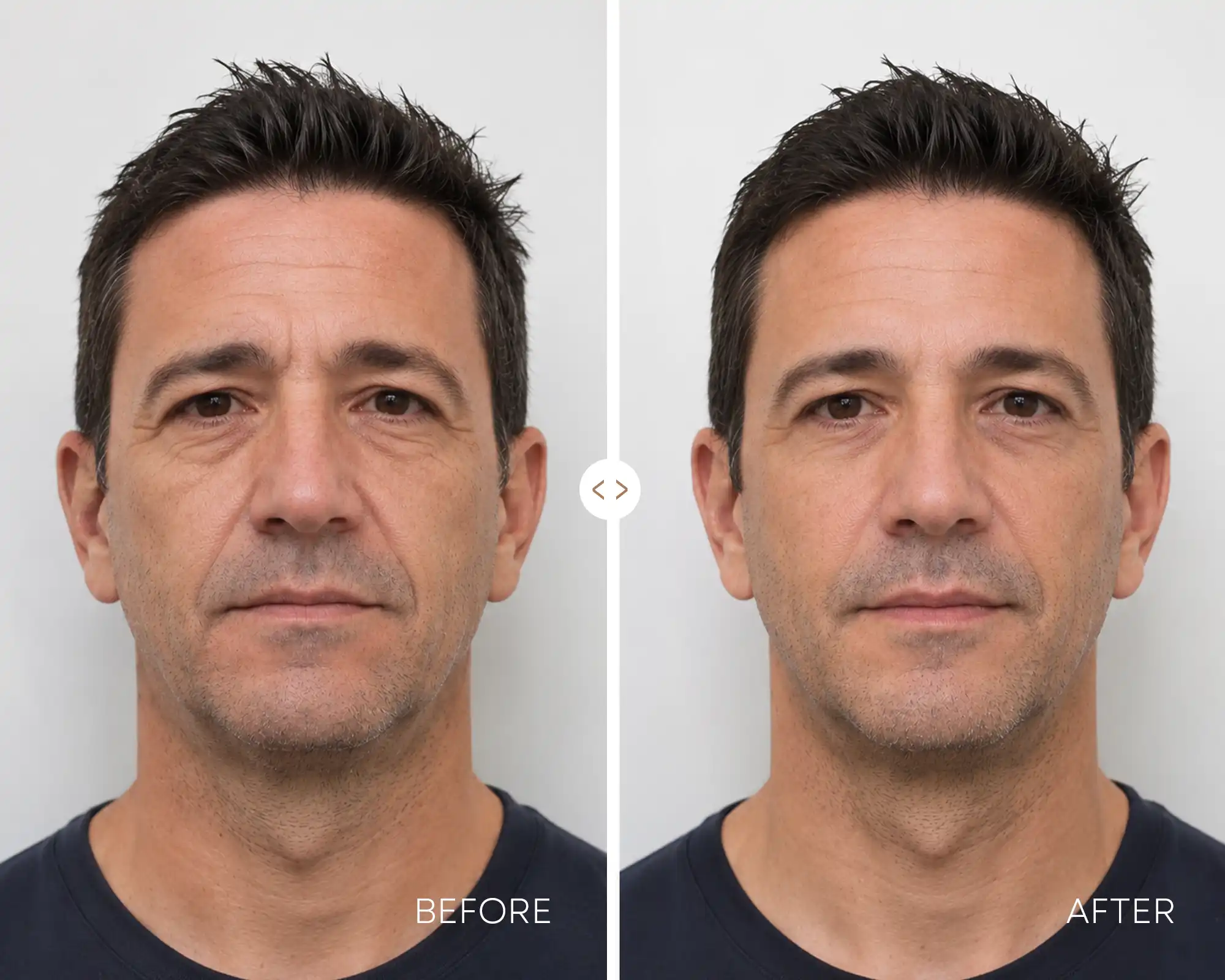 Lower face & neck tightening