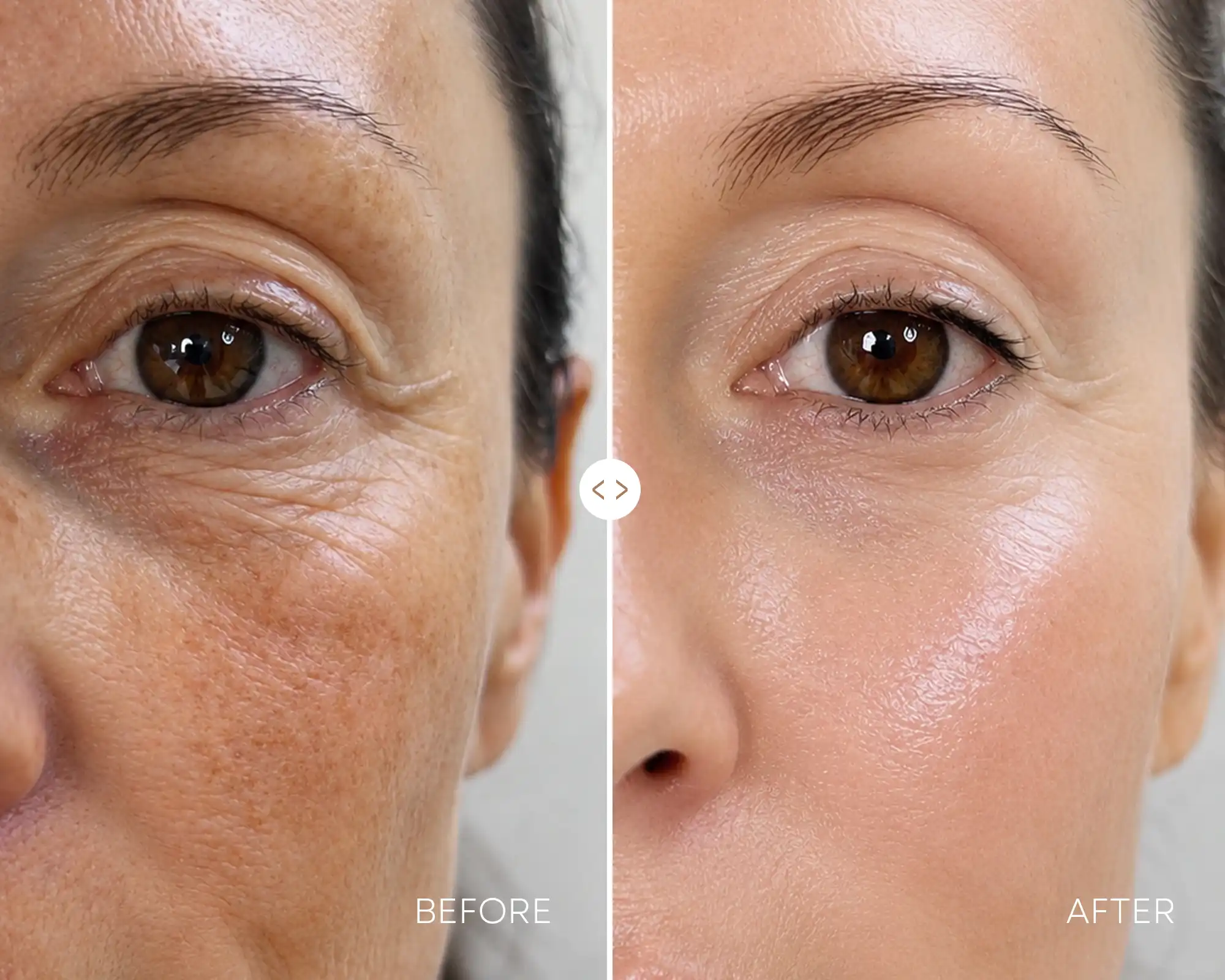 Lower face & neck tightening