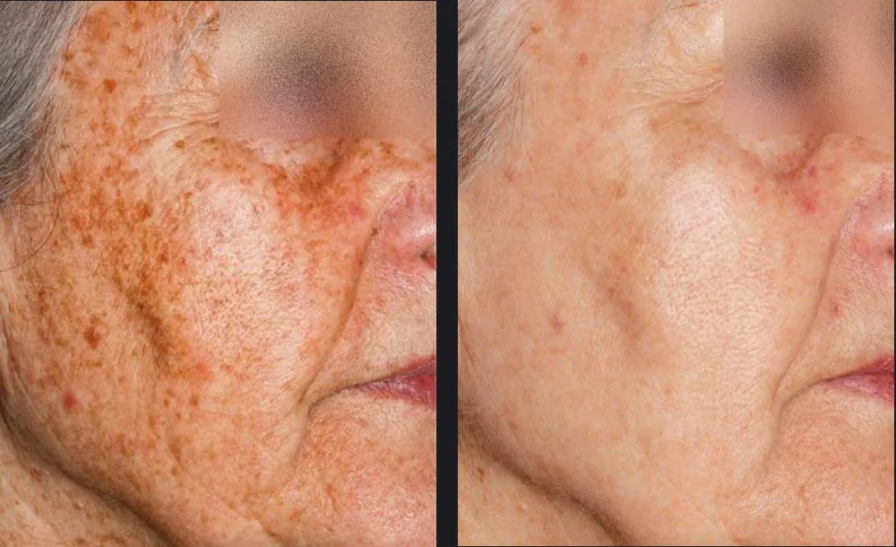 nordlys-pigmentation-guillermo-simon-md-p2.jpg (1)